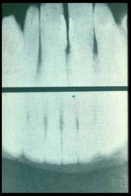 Enter Dentistry This radiograph was made on February 1 st, 1896 by Dr.