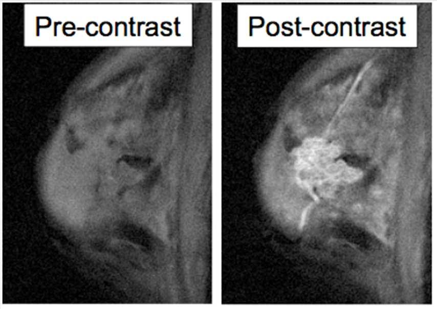 14.3 RELAXATION AND TISSUE CONTRAST 14.3.4 Contrast agents Example of tumour detection Pre-contrast, no lesion is visible Post-contrast (intra-vascular
