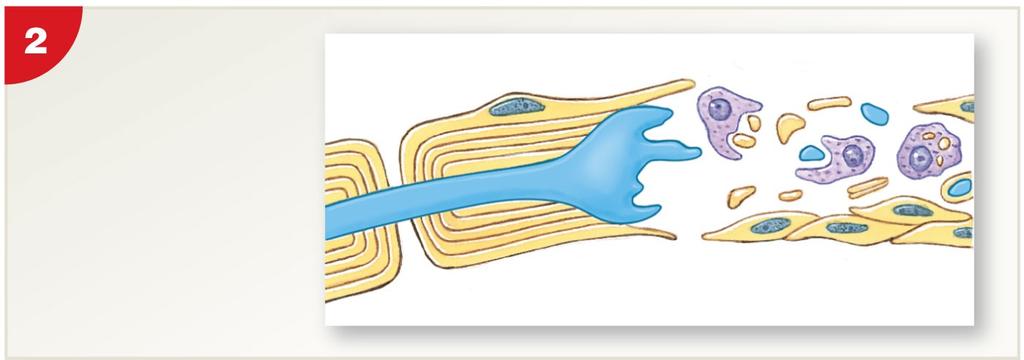 Figure 12-7 Peripheral Nerve Regeneration after Injury Schwann cells form cord, grow into cut, and