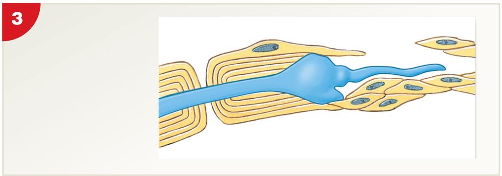 Figure 12-7 Peripheral Nerve Regeneration after Injury Axon sends buds into