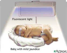Irradiating babies with jaundice causes a photochemical change that