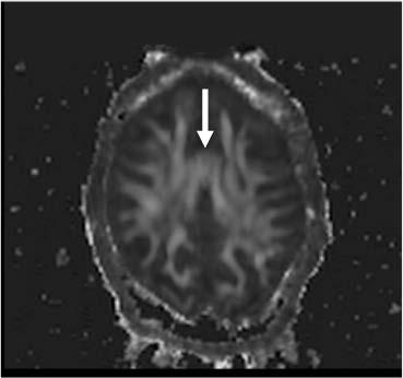 69 Figure 2.8: F A artifact resulting from table vibrations. The increased F A appears in gray matter regions above the corpus callosum. Source: V. A. Magnotta, J. T. Matsui, D. Liu, H. J. Johnson, J.