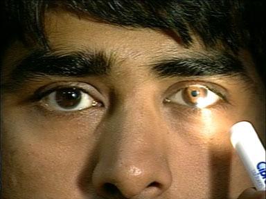 A Physiological Example - The Pupil Light Reflex This is due to inherent noise present in the reflex. the pupil has a well documented source of fluctuations known as pupillary hippus.