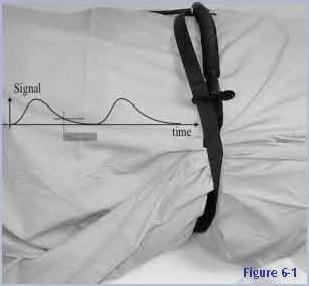 Abdomen Motion Correction Method #4: Respiratory gating incorporates the use of a bellows device placed around the patient s chest to track respiratory motion.