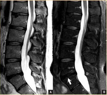 Spectral fat saturation is often also employed in the lumbar spine to facilitate the detection of lesions within the marrow on T 2 -weighted scans.