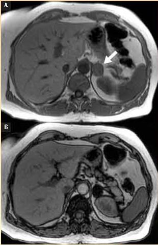 Fat Suppression (In-Phase, Opposed-Phase) Example: Nonhyperfunctioning adrenal adenoma, on (A) in-phase and (B) opposed-phase images (reprinted with permission from Clinical Magnetic Resonance