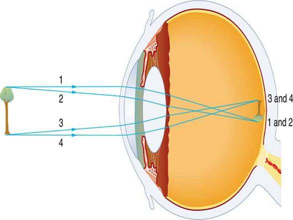 Lenses that are thicker in the center are called convex (converging) lenses. When the object is within one focal length of the lens, the image produced is upright, enlarged and virtual.