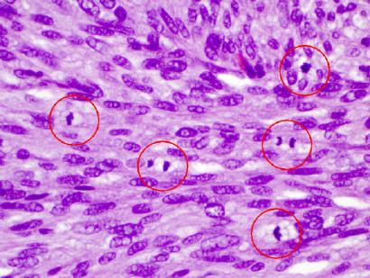 shape) well differentiated (cell specialization) Abnormal cells