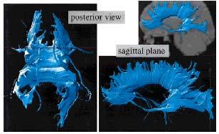 TRACTOGRAPHY Use regions of white matter
