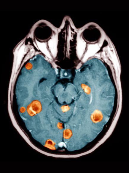 Finding Malignant Tumors from MRI Scans Attributes 1. Shape circular,oval 2. Size large,small 3.