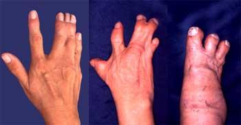 Synpolydactyly (SPD) caused by dominant HoxD13 mutation heterozygote homozygote Poly-Alanine tracts are common in transcription factors, especially homeodomain tfs, have some unclear role in