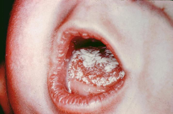 Causes white patches on mouth and plaques on tongue.