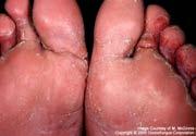 chytrid infection Athlete s foot Dermatophytosis ( ringworm )