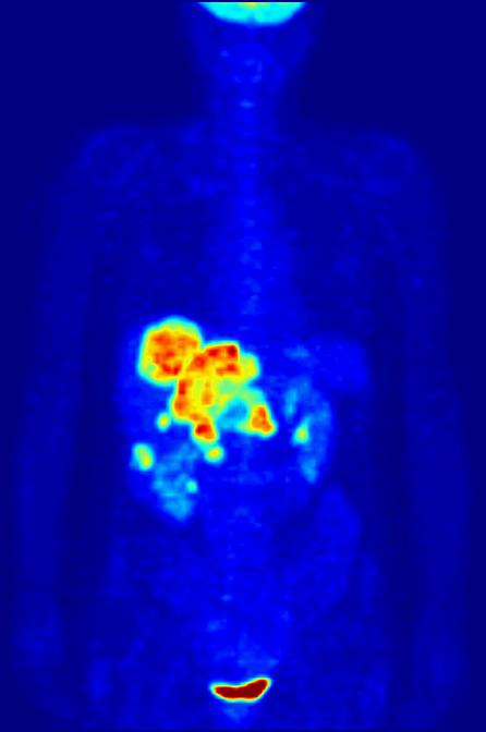 Full body PET scan using 18 F (intravenously administered one hour prior).