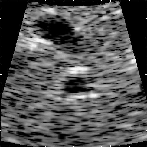 Speckle pattern in ultrasound image 4 x 4 cm image of a human liver for a 28-year old male. Speckle pattern in liver. The dark areas are blood vessels.