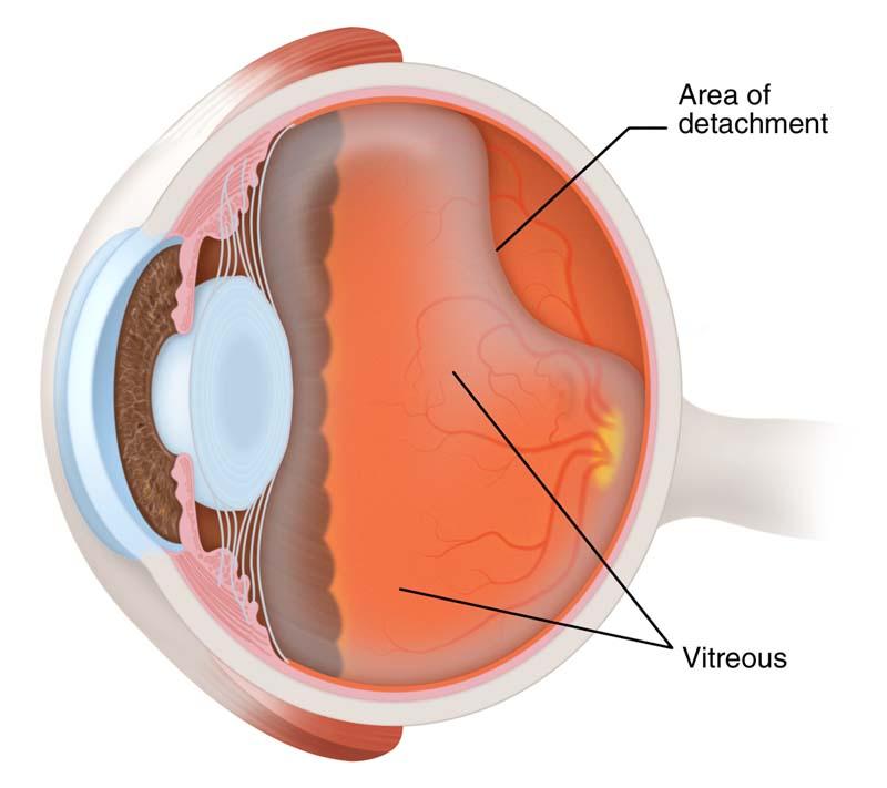 Posterior Vitreous Detachment (PVD) It typically has no