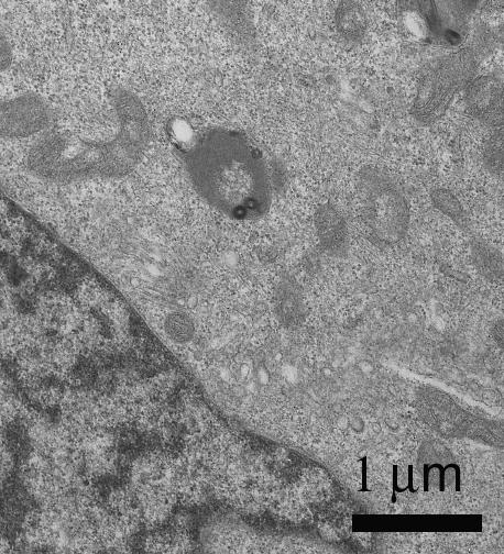 a b Figure 5.4 Transmission Electron Microscope images showing uptake of 500 nm positively charged SNTs in MDA-MB-231 cells.