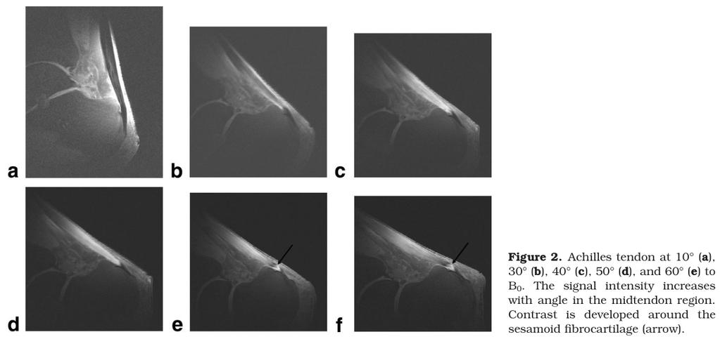 Example: Tendon Imaging T 2 of tendons is strongly dependent on the angular orientation with