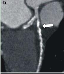 MRI, 2010 DE Cardiac ccta shows subtotal