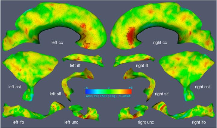 Flattening for White Matter Tracts 2D t-statistic