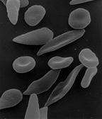 Malaria and Sickle-cell Anemia Single