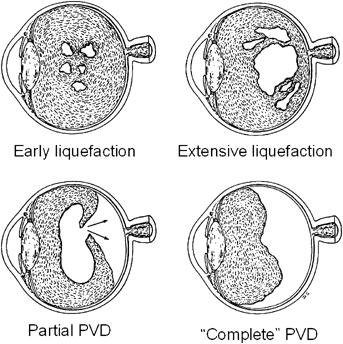 Vitreous remodeling Age-related vitreous liquefaction and PVD. Pockets of liquid appear within the central vitreous that gradually coalesce.