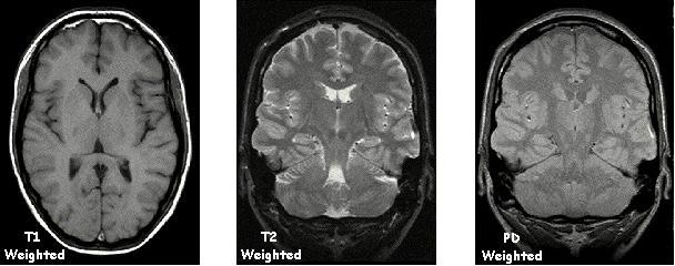 Figure 1.8: Different contrast MR images of a slice of a human brain. were introduced by Pauly et al. in respectively [16] and [17].