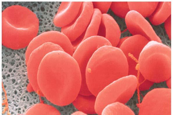 Sickle cell anemia would be the first genetic disease to be described at the molecular level.