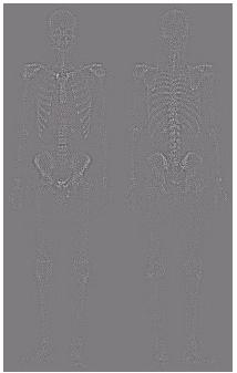 Combining Spatial Enhancement Methods (a) Laplacian ilter o bone scan (a) (b) Sharpened
