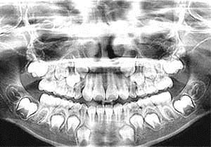 = 0.00243 nm Application Formative Quiz Dental X - Rays X-rays of wavelength = 22 pm are scattered from a carbon target and the scattered x-rays are detected at 85 0 to