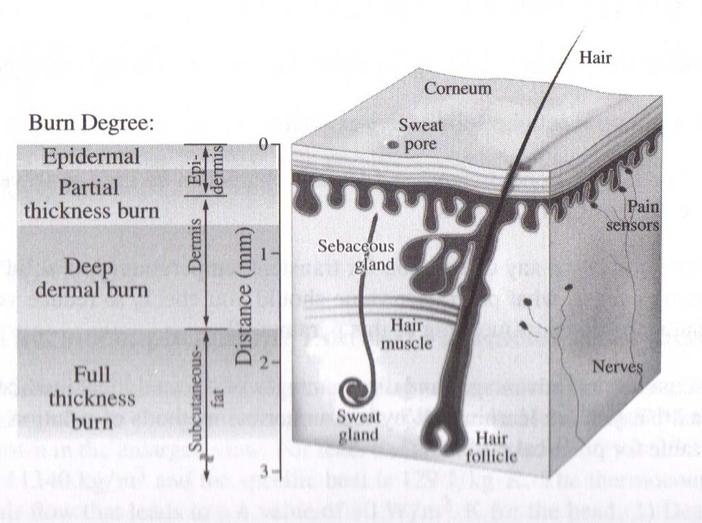 Example 3 Analyi of Skin Burn Figure 15. Section of a kin with degree of burn uperimpoed on it.