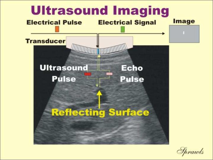 Ultrasound We hear only certain frequencies: 16-20 Hz 20 khz Ultrasound: aboe 20 khz 2-20 MHz used in medicine for diagnostic purposes Imaging of the body, examining