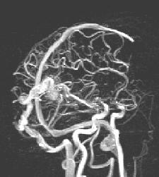 Magnetic Resonance Angiography MR Angiography MR scanner tuned to measure only moving structures Sees