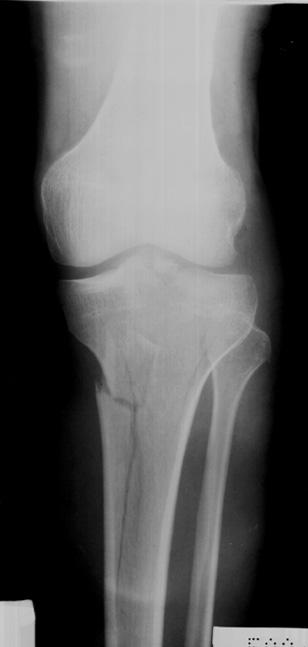 X-radiography Greenstick - an incomplete fracture in which the bone bends Transverse - a fracture that