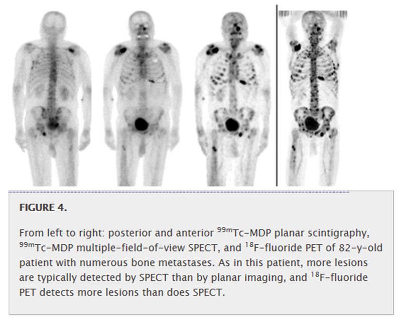 Overview NM Scintigraphy, SPECT, PET Emission Detection Planar Imaging (Scintigraphy) Single gamma photon (produced by isomeric transition) Anger camera Projection imaging SPECT PET Single gamma