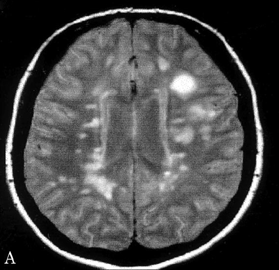 Example: Multiple Sclerosis T 2 Image