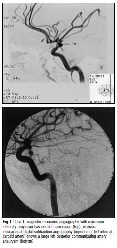 Johnson et al (2001) consider Bayesian inference in for Magnetic Resonance Angiography (MRA). An Aneurysm is a localized, blood-filled balloon-like bulge in the wall of a blood vessel.