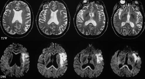 weighted MRI 3 hours after a stroke diffusion