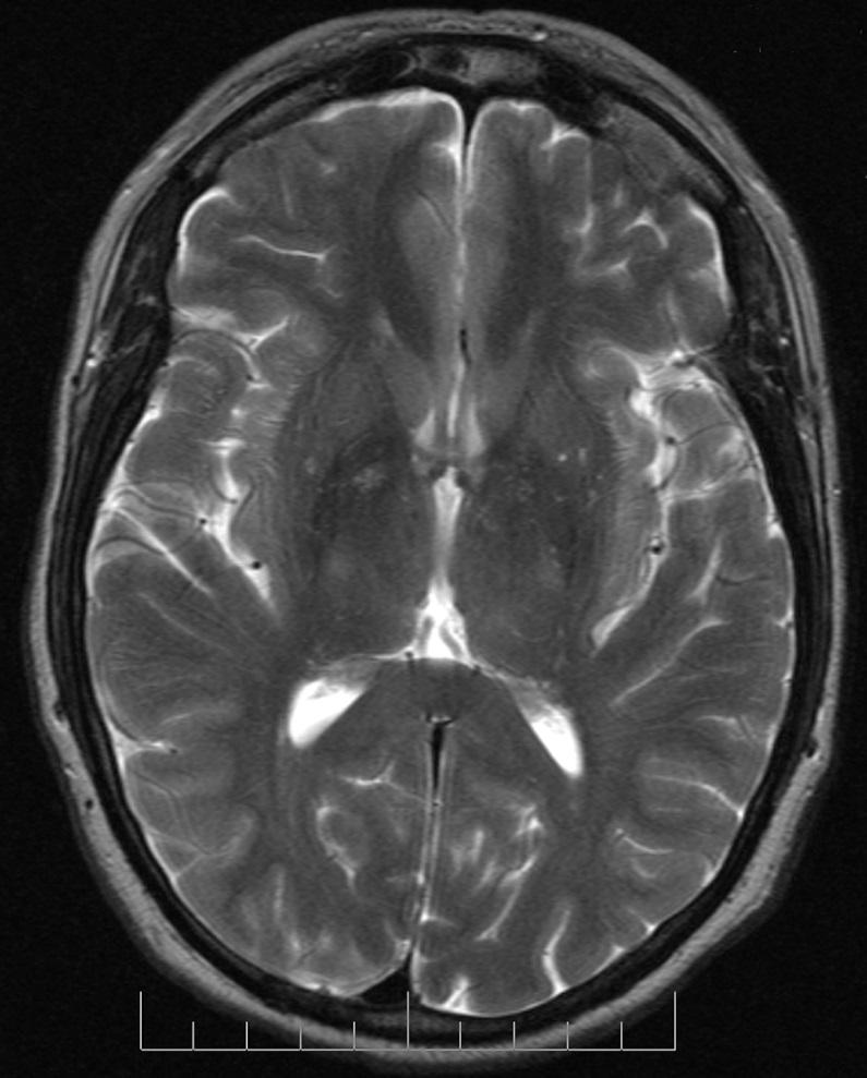 diffusion tensor imaging (DTI) [ File:MRI T2 Brain axial image.
