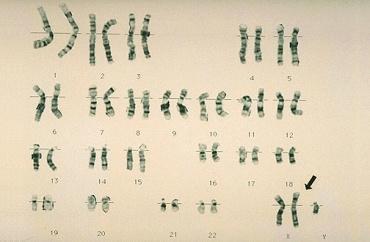 Genetic Disorders Kleinfelter s Syndrome= Trisomy 23 Extra sex chromosome