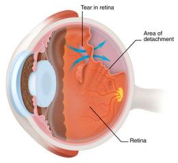Retinal detachment Background Posterior vitreous detachment (PVD) and vitreous degeneration: more common in myopic eyes; preceded by changes in vitreous macromolecular structure and in vitreoretinal