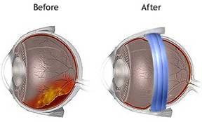 Background Scleral buckling and vitrectomy Scleral bluckling Scleral buckling is the application of a rubber band