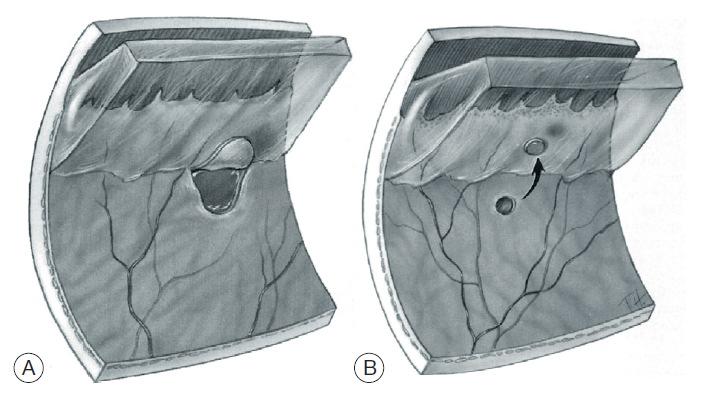 Background The retinal detachment: cases considered here A) horseshoe tear (when large, >90, GRT), B)