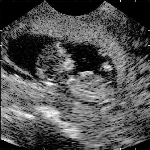 Fetus Head Amniotic fluid Scattering and imaging Amniotic fluid Mouth Boundary of placenta Foot Spine Ultrasound image of 3th week fetus.
