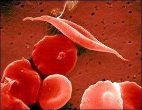 Sickle Cell Is a Point Mutation Sickle Cell is an Example of an Inborn Error of
