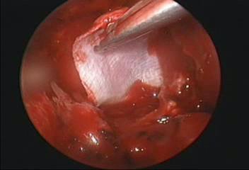 the R endoscopy video sequence