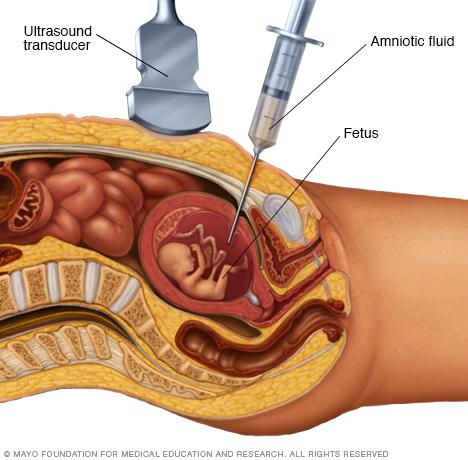 Unit 3:Macro genetics Amniocentesis Amniocentesis Takes sample of amniotic fluid (the liquid the fetus