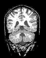 results shown in Figures 10 and 11. Notice how the gray and white matter is well differentiated in the cerebellum in A25.