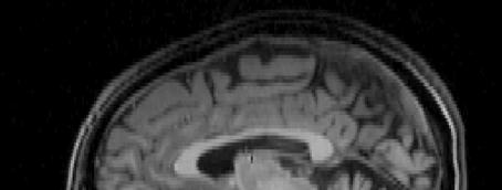 BOLD artifacts fmri is a T2*