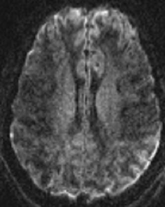 T2* Reduced T1 Different MRI
